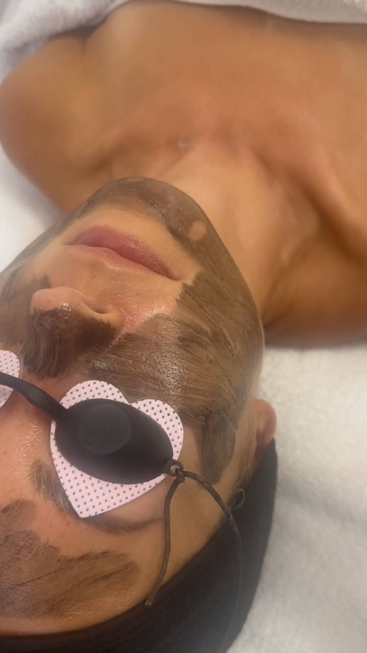 Carbon peel